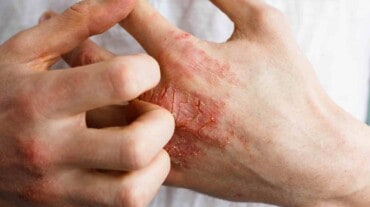 Treatment of psoriasis